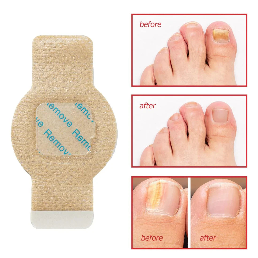 NailHeal™ – Fungal Nail Repair Patches 🌿💅 (Buy 1 Get 1 Free 🔥🔥)